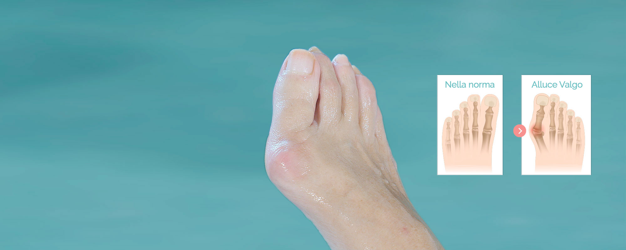 <b>Bunion (Hallux Valgus)</b>